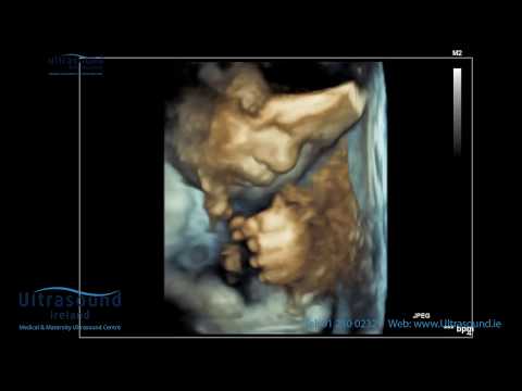 Scan of the Week: 34 Week 3D/4D Bonding Baby Scan
