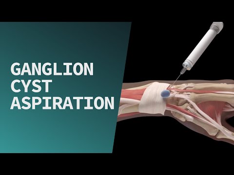 Ganglion Cyst Aspiration